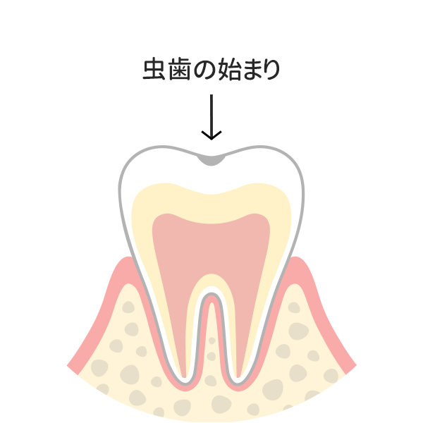 歯の表面の脱灰