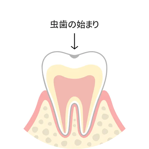 歯の表面の脱灰