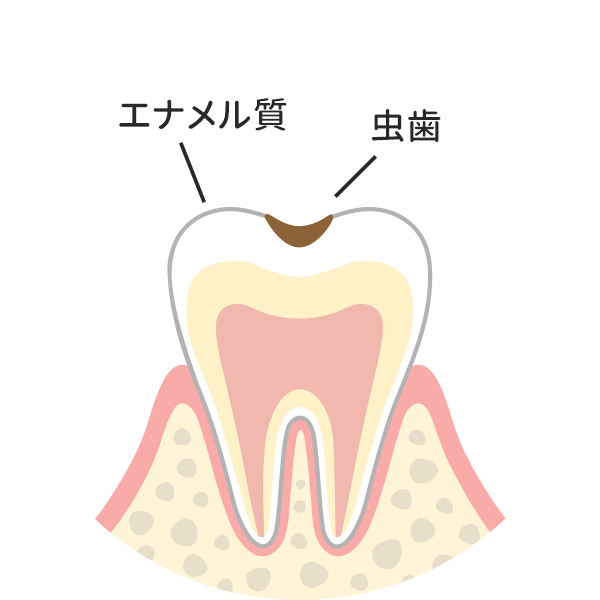 歯の表層（エナメル質）の虫歯