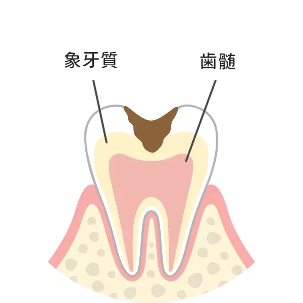 歯の中（象牙質）まで進んだ虫歯