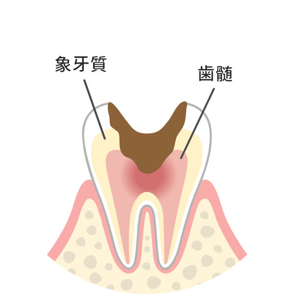 歯の神経まで達した虫歯