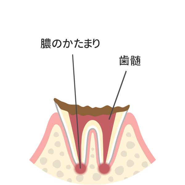 歯の根っこまで達した虫歯