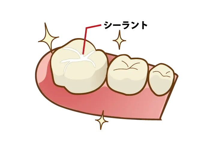 シーラント