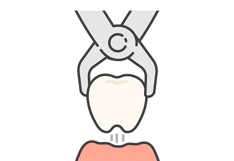 抜歯のリスクを減らせる