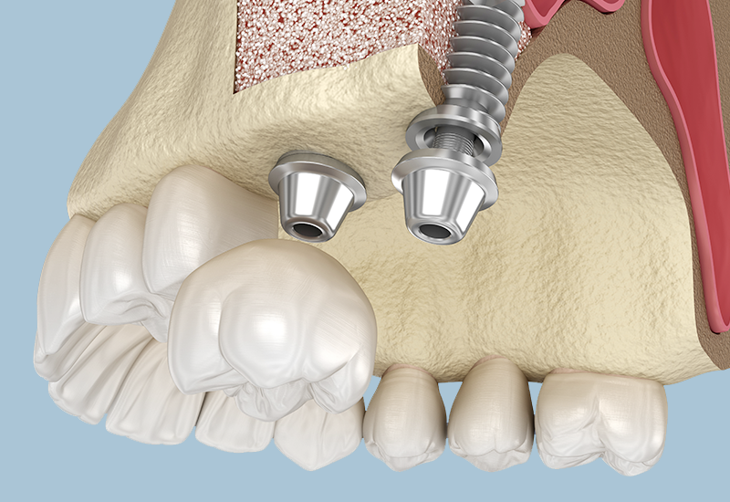 骨造成について