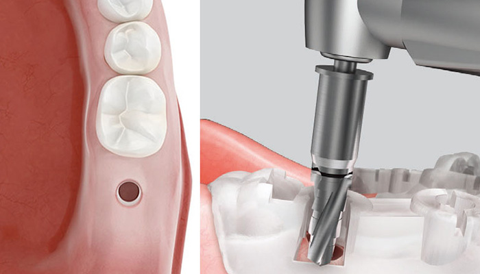 痛みを減らし回復は早く