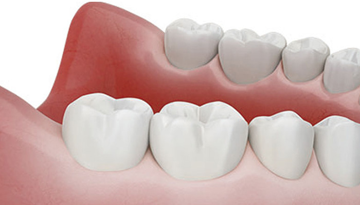 1日で自然な補綴が可能な場合も