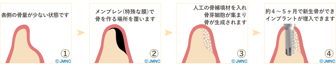 GBR（骨誘導再生法）