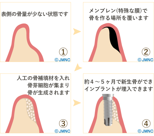 GBR（骨誘導再生法）