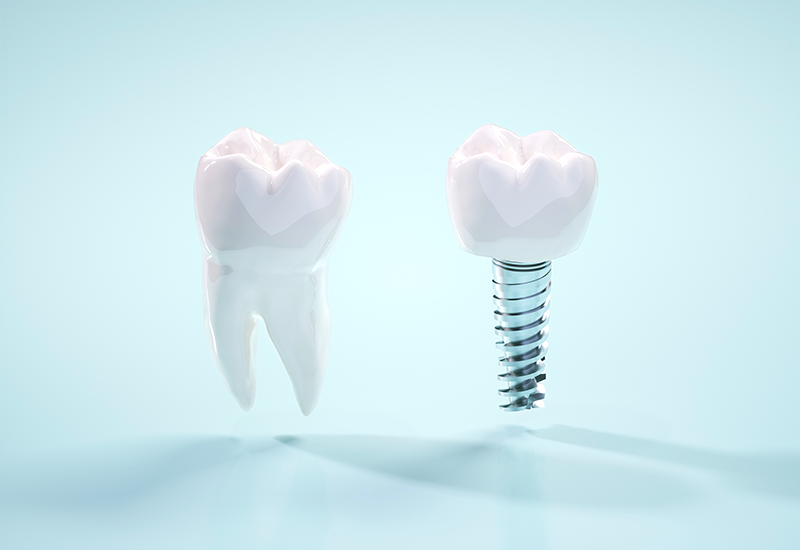 インプラント治療について