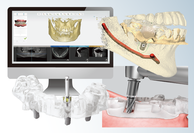デジタルワークフローによる精度の高い治療