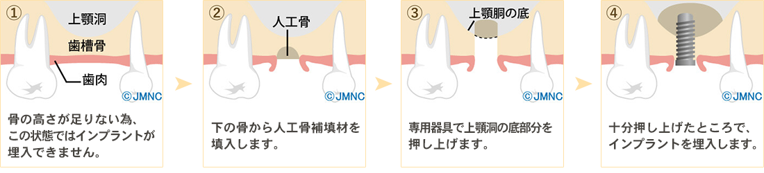 サイナスリフト法