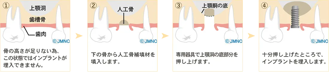 サイナスリフト法