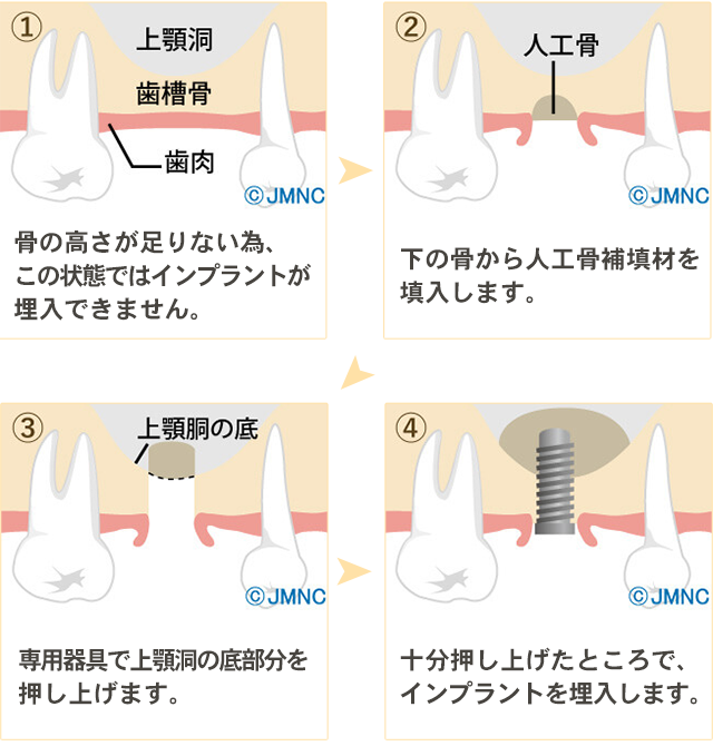 サイナスリフト法