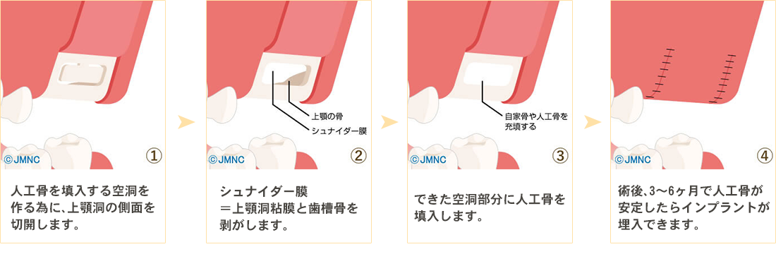 ソケットリフト法