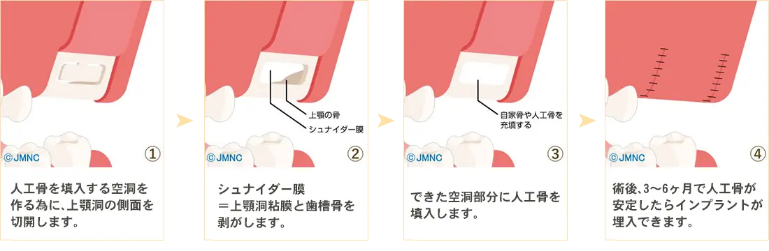 ソケットリフト法