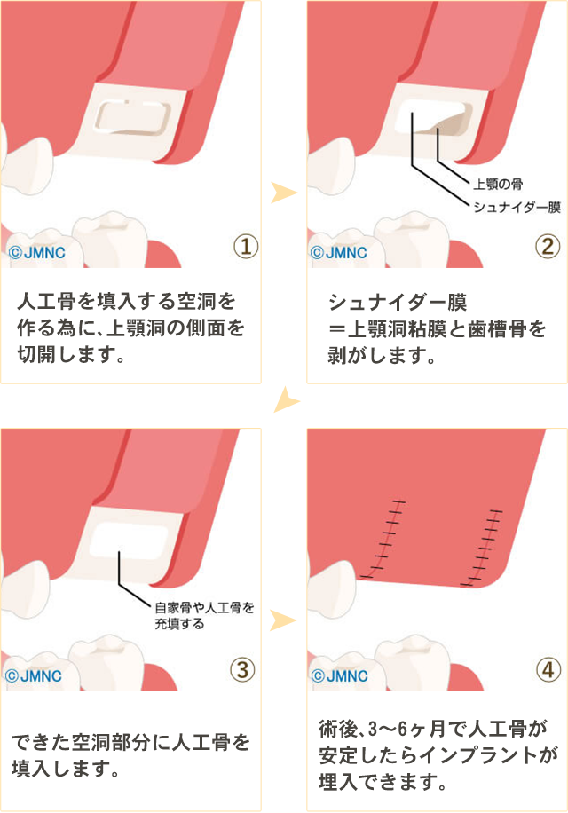 ソケットリフト法