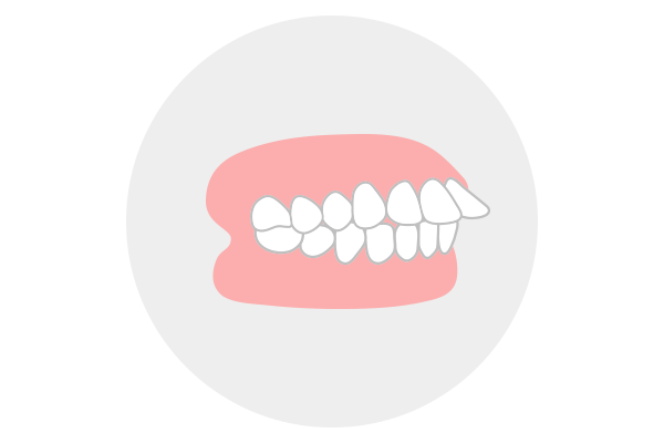 上顎前突（出っ歯）