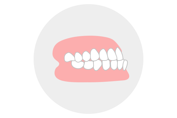 下顎前突（受け口）