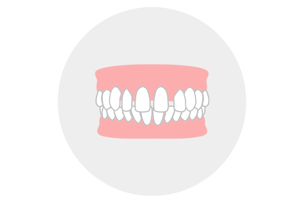 空隙歯列（すきっ歯）