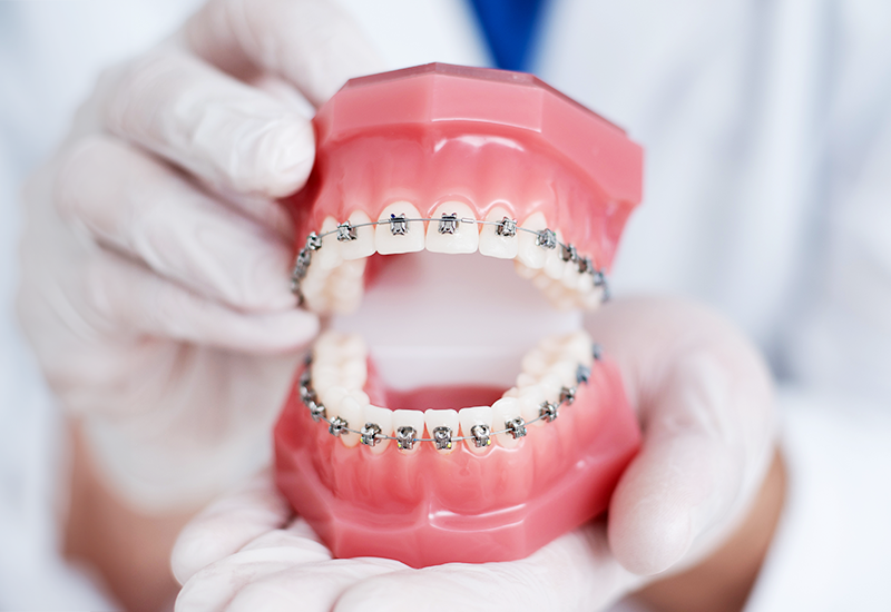 ワイヤー矯正について