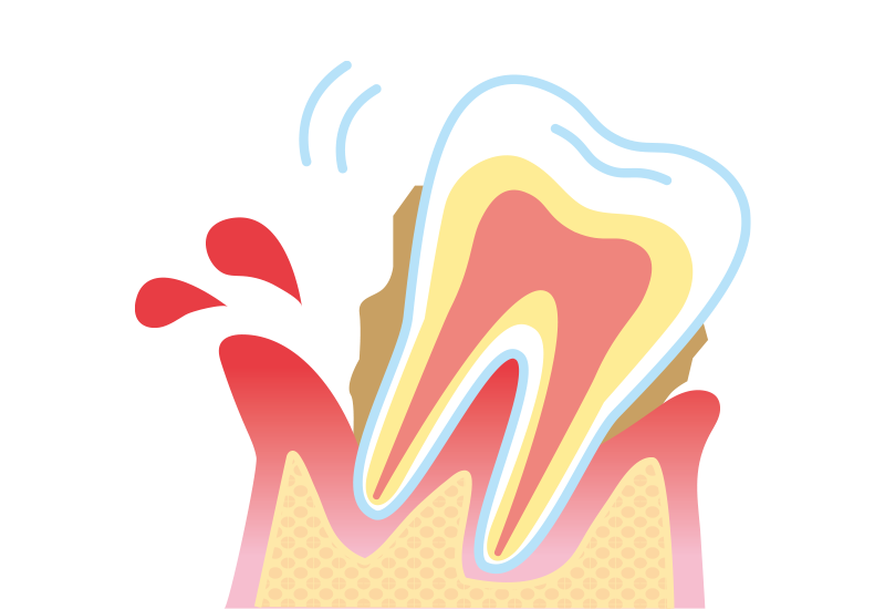 歯周病について