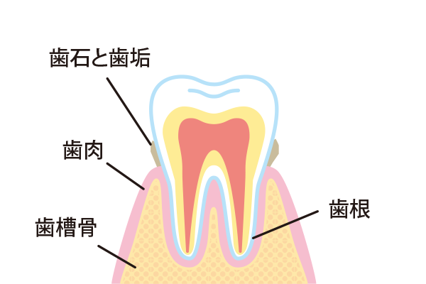 歯肉炎（初期）