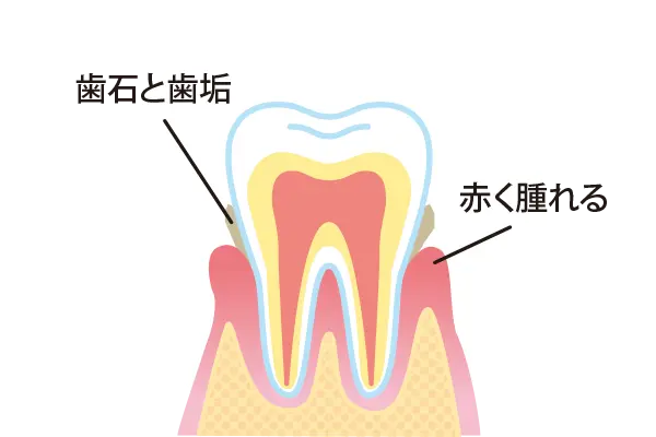 軽度歯周炎