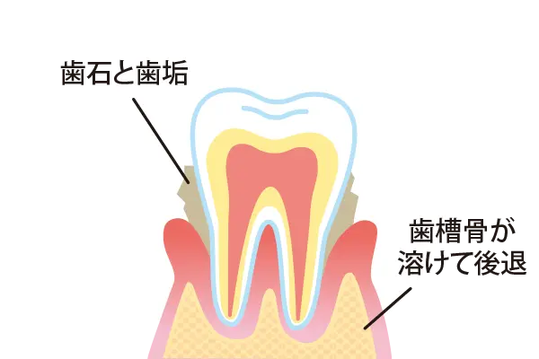 中等度歯周炎