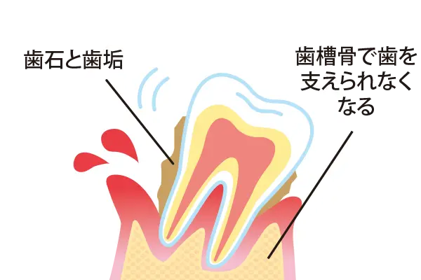 重度歯周炎