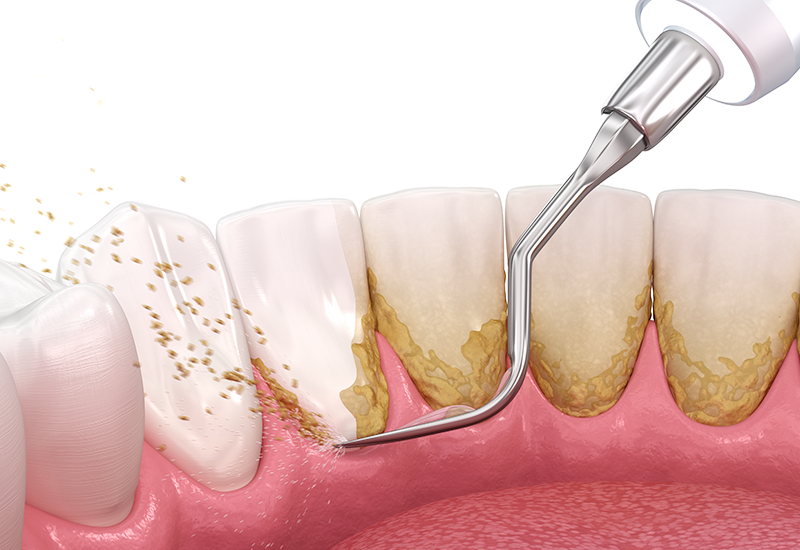 スケーリング・SRP