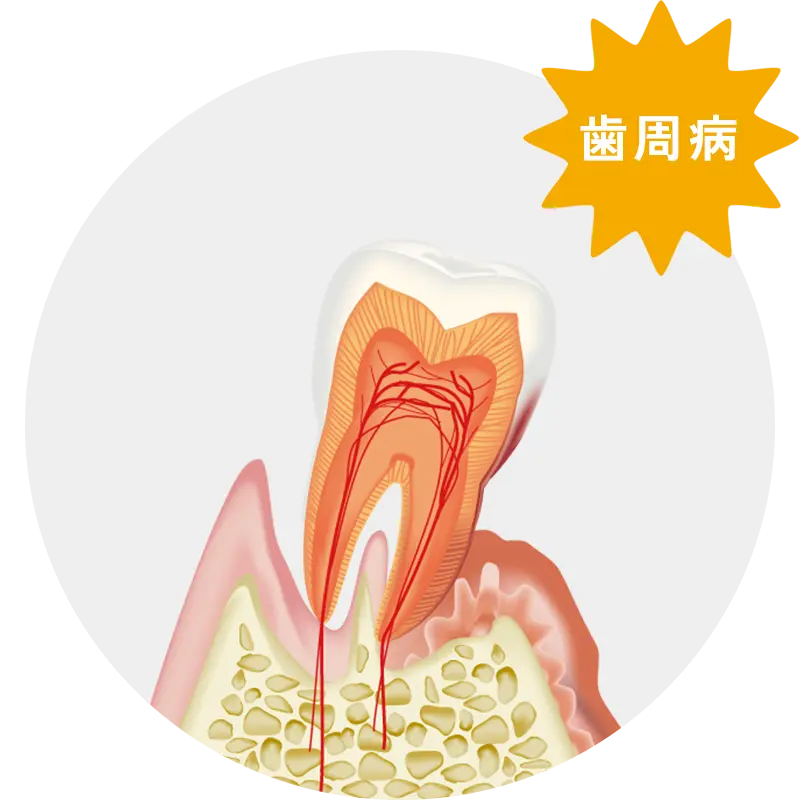歯周病